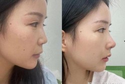 杭州整容爆料案件最新,揭开美容行业潜规则与维权困境